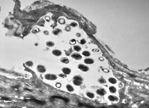 M,68y. | epidermis … otitis externa (mycotic v.s.)